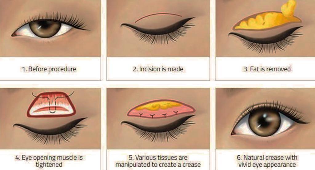 double eyelid incision process
