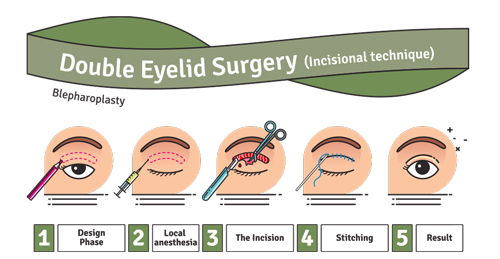 incisional double eyelid surgery