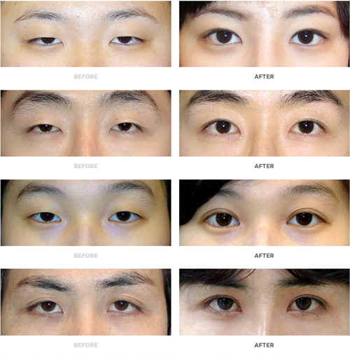 double eyelid before after