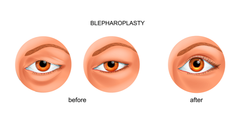 upper-blepharoplasty-droopy-eyelids (1)