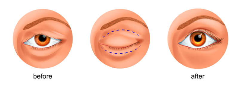 before and after blepharoplasty for ptosis diagram