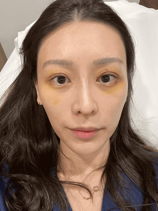 1 week after double eyelid surgery